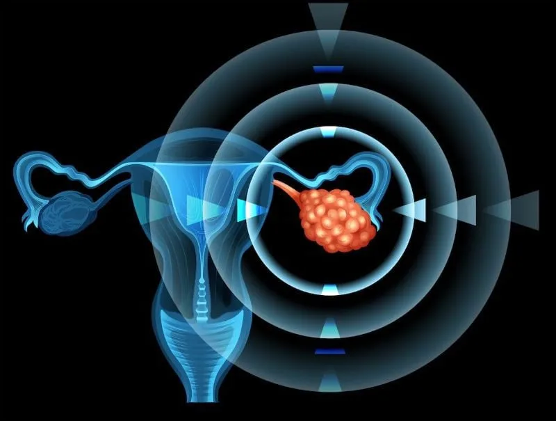 scientists from oxford successfully developed vaccine against ovarian cancer photo file